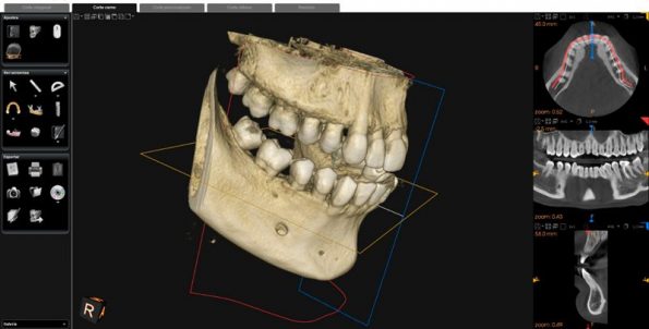 TAC 3D Dental de 2 arcadas en Pinto - Imagen 2